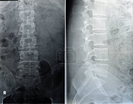 Photo for Plain X ray lumbosacral spine revealed straightened, mild scoliotic deformity of  lumber spine, spondylotic changes, bilateral Sacroiliitis, mild narrowing of L4-L5, L5- S1 disc spaces - Royalty Free Image