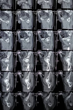 Foto de El Cairo, Egipto, 21 de noviembre de 2023: la tomografía computarizada no mejorada de la pelvis reveló anterolistesis de grado I de L4 y L5 lítica degenerativa, vejiga urinaria normal, órganos pélvicos normales, sin linfadenopatía - Imagen libre de derechos