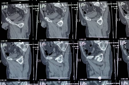 Foto de El Cairo, Egipto, 21 de noviembre de 2023: la tomografía computarizada no mejorada de la pelvis reveló anterolistesis de grado I de L4 y L5 lítica degenerativa, vejiga urinaria normal, órganos pélvicos normales, sin linfadenopatía - Imagen libre de derechos