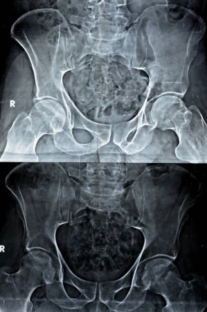 Foto de La radiografía simple de ambas articulaciones de la cadera reveló un ligero estrechamiento del aspecto superolateral de ambas articulaciones de la cadera espacios con esclerosis subcondral de la opuesta acetabular denotando cambios osteoartríticos - Imagen libre de derechos