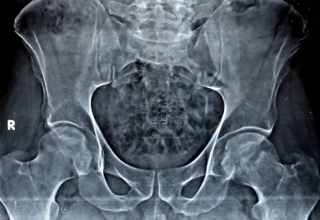 Foto de La radiografía simple de ambas articulaciones de la cadera reveló un ligero estrechamiento del aspecto superolateral de ambas articulaciones de la cadera espacios con esclerosis subcondral de la opuesta acetabular denotando cambios osteoartríticos - Imagen libre de derechos