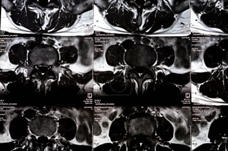 Foto de Cairo, Egipto, 24 de diciembre de 2023: Vértebras Laminectomía espinal, descompresión del saco posterior, espondilosis lumbar, protrusiones del disco posterior de L3-4, L4-5, protrusión central de L5-S1 - Imagen libre de derechos