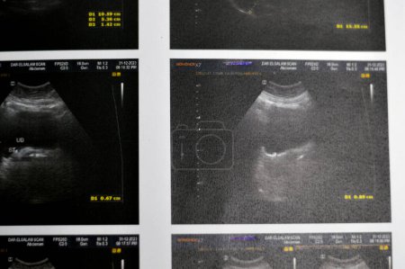 Téléchargez les photos : Le Caire, Égypte, 2 janvier 2024 : l'échographie abdominale pelvienne révèle une pierre vésiculo-urétérique droite avec des changements obstructifs modérés, une pierre de la vessie, une focalisation sélective - en image libre de droit