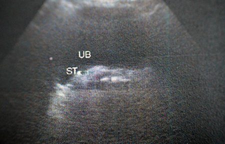 Téléchargez les photos : L'échographie pelviabdominale révèle une pierre de 9mm à la jonction vésiculo-urétérique droite, avec des changements obstructifs modérés à droite et une pierre solitaire de 1 cm à l'intérieur de la vessie, foyer sélectif - en image libre de droit