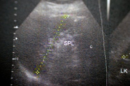 Téléchargez les photos : La rate d'une taille moyenne 10 CM, et d'une texture homogène uniforme, aucune lésion focale n'a pu être observée dans une échographie abdominale pelvienne chez une patiente, foyer sélectif - en image libre de droit