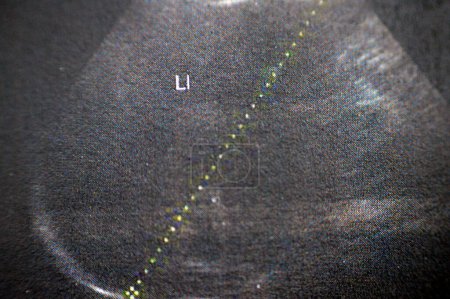 Téléchargez les photos : Le foie est de taille moyenne 15 cm, avec une échogénicité homogène, aucune lésion focale ou radicaux intra-hépatiques dilatés, échographie abdominale pelvienne d'une patiente, foyer sélectif - en image libre de droit