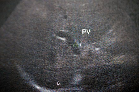 Téléchargez les photos : Veine porte est vu brevet avec calibre normal 9 mm dans une échographie abdominale pelvi pour une patiente, foyer sélectif - en image libre de droit