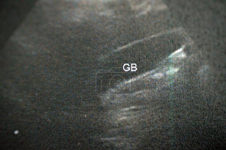 ultrasonografia