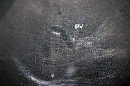 Téléchargez les photos : Veine porte est vu brevet avec calibre normal 9 mm dans une échographie abdominale pelvi pour une patiente, foyer sélectif - en image libre de droit