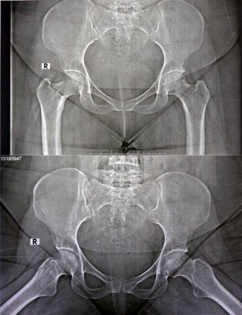 Photo for Plain X ray reveals bilateral Avascular necrosis (AVN) of the femoral head more in the left side, a type of aseptic osteonecrosis, which is caused disruption of the blood supply to the proximal femur - Royalty Free Image