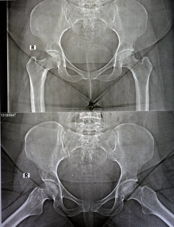 Einfaches Röntgenbild zeigt eine bilaterale avaskuläre Nekrose (AVN) des Femoralkopfes mehr in der linken Seite, eine Art aseptische Osteonekrose, die zu einer Unterbrechung der Blutversorgung des proximalen Femurs führt.