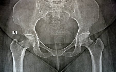 Photo for Plain X ray reveals bilateral Avascular necrosis (AVN) of the femoral head more in the left side, a type of aseptic osteonecrosis, which is caused disruption of the blood supply to the proximal femur - Royalty Free Image