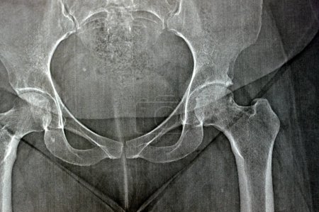 Foto de La radiografía simple revela necrosis avascular bilateral (NAV) de la cabeza femoral más en el lado izquierdo, un tipo de osteonecrosis aséptica, que es causada por la interrupción del suministro de sangre al fémur proximal - Imagen libre de derechos