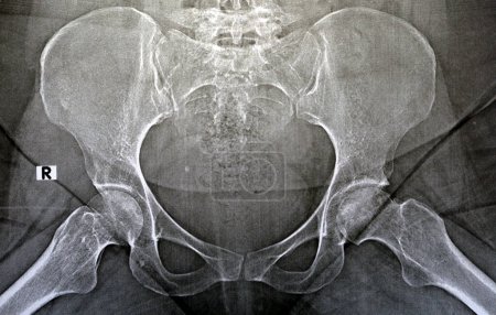 Einfaches Röntgenbild zeigt eine bilaterale avaskuläre Nekrose (AVN) des Femoralkopfes mehr in der linken Seite, eine Art aseptische Osteonekrose, die zu einer Unterbrechung der Blutversorgung des proximalen Femurs führt.
