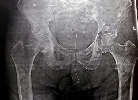 Photo for High probability of subtrochanteric, trochanteric fissure fracture, and malignancy metastasis in medial side of the upper femur shaft, of an old patient with prostate cancer with urinary catheter - Royalty Free Image