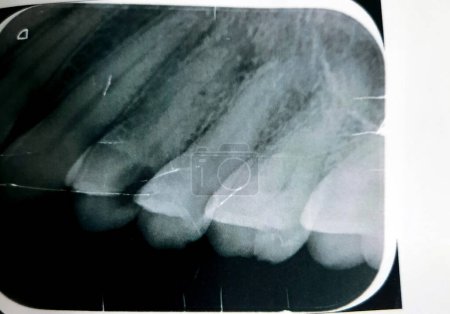 Photo for X ray reveals dental inflammation, abscess, a collection of pus that can form inside the teeth, in the gums, or in the bone that holds the teeth in place caused by bacterial infection, selective focus - Royalty Free Image