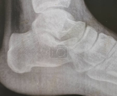 heel calcaneal spur, a calcium deposit causing a bony protrusion on the underside of the heel bone also Plantar Fasciitis , inflammation of the plantar fascia tissue of the foot used in walking