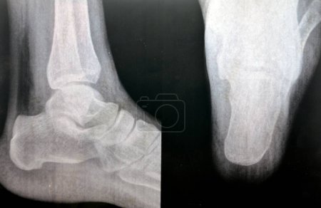 heel calcaneal spur, a calcium deposit causing a bony protrusion on the underside of the heel bone also Plantar Fasciitis , inflammation of the plantar fascia tissue of the foot used in walking