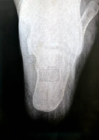 espolón calcáneo del talón, un depósito de calcio que causa una protrusión ósea en la parte inferior del hueso del talón también Fascitis plantar, inflamación del tejido de la fascia plantar del pie utilizado en caminar
