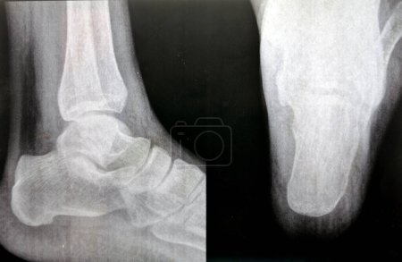 espolón calcáneo del talón, un depósito de calcio que causa una protrusión ósea en la parte inferior del hueso del talón también Fascitis plantar, inflamación del tejido de la fascia plantar del pie utilizado en caminar