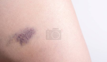 Photo for Closeup Blue Purple Hematoma, Bruise On Thigh, Hip After Trauma, Fall. Horizontal plane. Clotted Blood, Injury On Human Body Concept. Copy Space For Text. High quality photo - Royalty Free Image