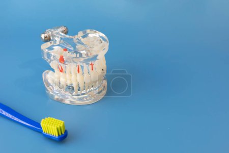 Photo for Transparent Pathological Tooth Model. Dental Education Implant Equipment And Toothbrush on Blue Background. Copy Space For text. Horizontal Mockup. Dentistry and Oral Health. High quality photo - Royalty Free Image