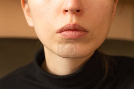 Photo for Young woman's lips infected herpes virus. Painful emotionless look. Diseases in winter and spring. Skin care and daily hygiene. - Royalty Free Image