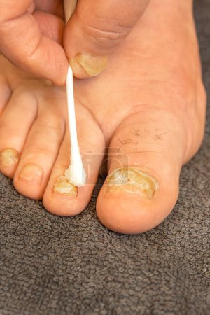 Treatment of patients with toenail onycholysis is medicinal with the help of ointment. Close-up