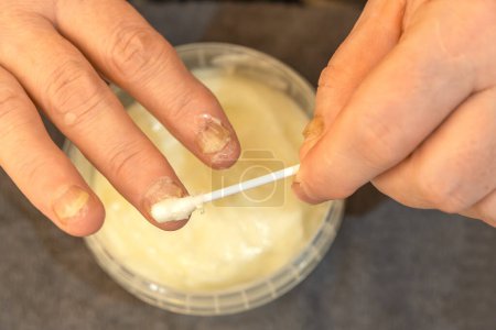 Frau behandelt ihre Hände mit von Onycholyse betroffenen Nägeln mit medizinischer Salbe. Nahaufnahme