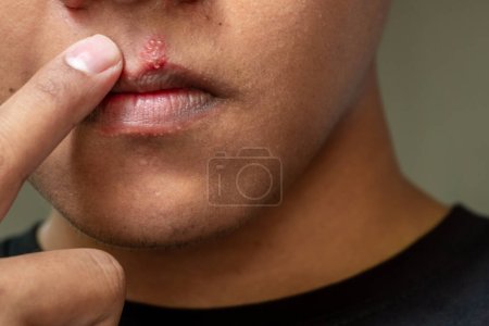 Foto de Los labios de los hombres afectados herpes ampollas. Virus del herpes y tratamiento de infecciones - Imagen libre de derechos