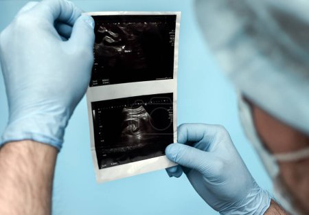 Photo for Urologist doctor analyzes an ultrasound of a person's kidney, a stone or calculus in the kidney on an ultrasound. Male urinary tract disease. Calculus in the ureter oxalate 8 mm. - Royalty Free Image