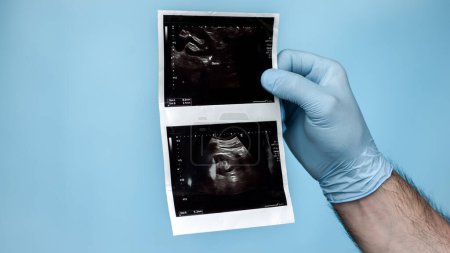 Foto de El médico urólogo analiza un ultrasonido del riñón de una persona, un cálculo o un cálculo en el riñón en un ultrasonido. Enfermedad del tracto urinario masculino. - Imagen libre de derechos