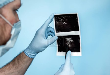 Foto de En el hospital, un médico urólogo analiza un ultrasonido del riñón de una persona en la radiografía, un cálculo o un cálculo en el riñón en la ecografía en las manos del médico. Enfermedad del tracto urinario masculino. Cálculo en el uréter oxalato 8mm - Imagen libre de derechos