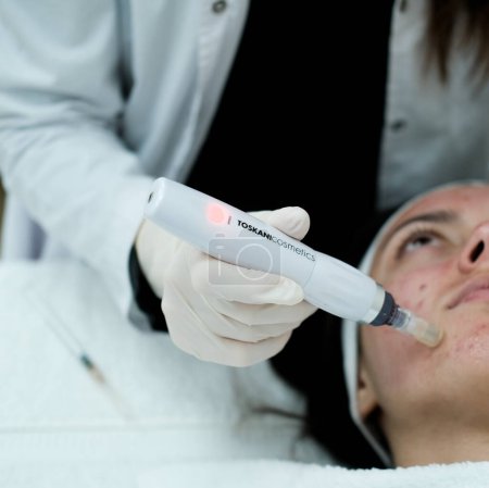 Foto de Vista de cerca del cosmetólogo que realiza el procedimiento de microneedling en la cara del paciente femeninoMicroneedling. Dermapen. Esteticista. Salud y belleza. - Imagen libre de derechos