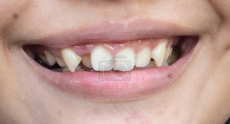 Téléchargez les photos : Dents dentelées d'une jeune femme - en image libre de droit