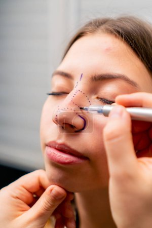 Foto de Primer plano cirujano plástico hace marcas en la cara de un paciente durante una consulta antes de la operación de la nariz - Imagen libre de derechos