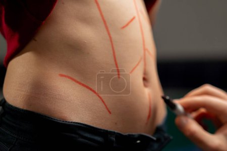 Téléchargez les photos : Gros plan dans une clinique de chirurgie plastique médecin fait des marques sur le ventre d'une jeune fille avant la chirurgie - en image libre de droit
