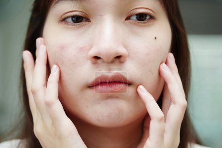 Téléchargez les photos : Acne pimple and scar on skin face, disorders of sebaceous glands, teenage girl skincare beauty problem. - en image libre de droit