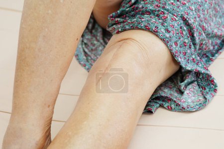 Téléchargez les photos : Asiatique femme âgée patient avec cicatrice genou chirurgie de remplacement à l'hôpital. - en image libre de droit