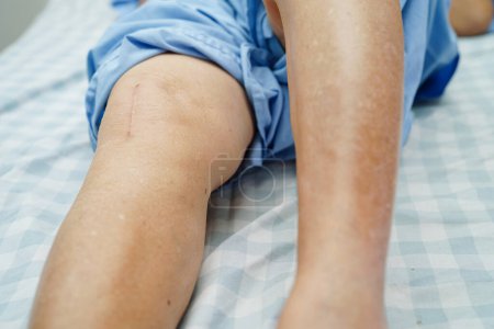 Foto de Asiática anciana paciente con cicatriz cirugía de reemplazo de rodilla en el hospital. - Imagen libre de derechos