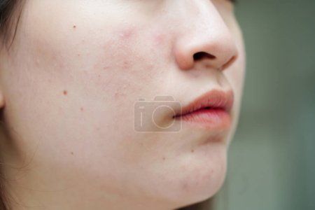 Téléchargez les photos : Acne pimple and scar on skin face, disorders of sebaceous glands, teenage girl skincare beauty problem. - en image libre de droit