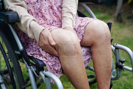 Foto de Asiática anciana paciente con cicatriz cirugía de reemplazo de rodilla en el hospital. - Imagen libre de derechos