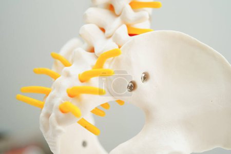 Foto de Nervio espinal y hueso, Fragmento de disco herniado desplazado de la columna lumbar, Modelo para tratamiento médico en el departamento ortopédico. - Imagen libre de derechos