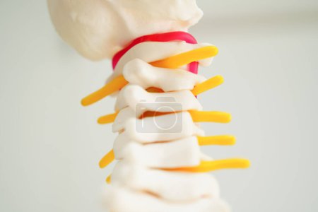 Foto de Nervio espinal y hueso, Fragmento de disco herniado desplazado de la columna lumbar, Modelo para tratamiento médico en el departamento ortopédico. - Imagen libre de derechos
