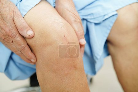 Téléchargez les photos : Asiatique femme âgée patient avec cicatrice genou chirurgie de remplacement à l'hôpital. - en image libre de droit