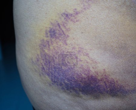 Foto de Moretones en la nalga lesiones en la piel por accidente en casa. - Imagen libre de derechos