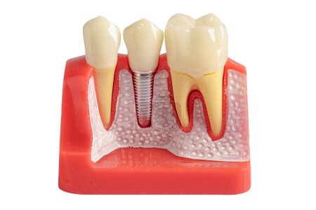 Dental implant, artificial tooth roots into jaw, root canal of dental treatment, gum disease, teeth model for dentist studying about dentistry.