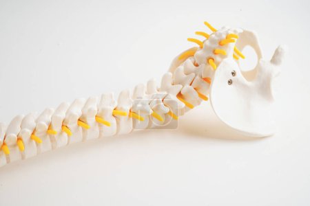 Wirbelsäule und Knochen, Lendenwirbelsäule verschoben Bandscheibenvorfall Fragment, Modell für die Behandlung in der orthopädischen Abteilung