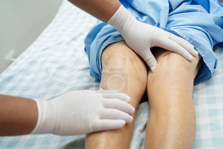 Foto de Médico revisando paciente anciana asiática con cicatriz cirugía de reemplazo de rodilla en el hospital. - Imagen libre de derechos