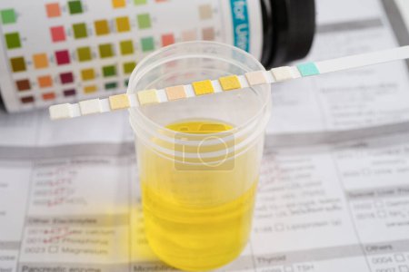 Urinanalyse, Urinbecher mit Reagenzstreifen-pH-Papier-Test und Vergleichstabelle im Labor.